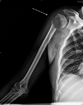 Proximal humerus pathological fracture due to metastatic renal cell carcinoma